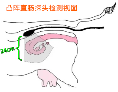 凸阵直肠探头